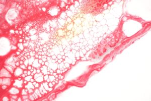 Photo celiac disease